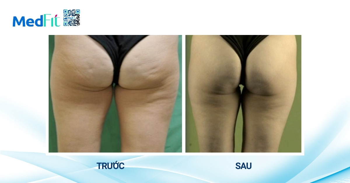 Hiệu quả giảm cellulite và làm thon gọn vòng mông của sóng xung kích