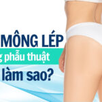 Nâng mông lép không phẫu thuật phải làm sao?