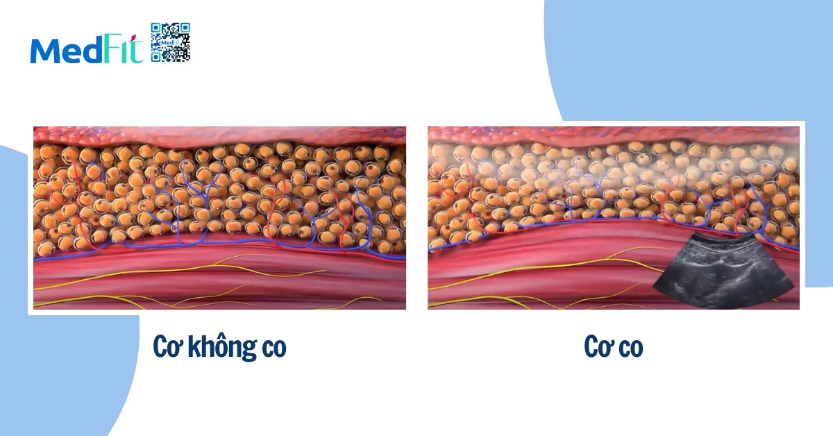 các máy tăng cơ công nghệ cao kích thích co cơ bắp