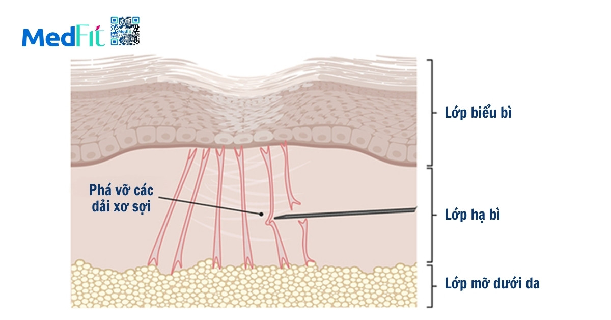 hình minh họa phương pháp bóc tách mô xơ dưới da