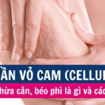 Da sần vỏ cam (cellulite) ở người thừa cân, béo phì là gì và cách điều trị
