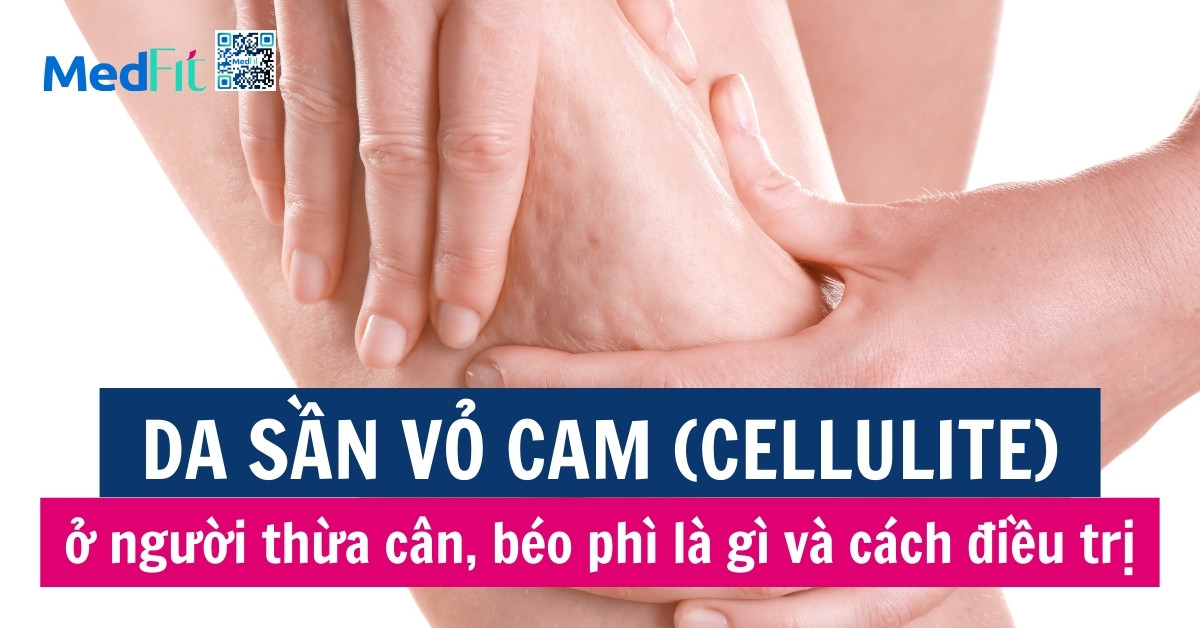 cellulite ở người thừa cân béo phì