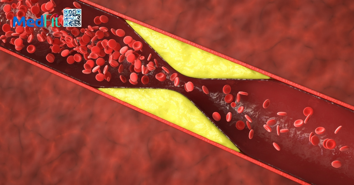 cholesterol dư thừa tích tụ trong thành động mạch