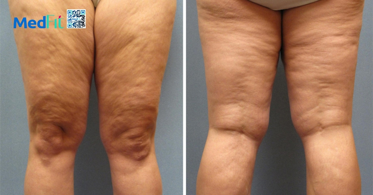 da sần vỏ cam (cellulite) ở đùi