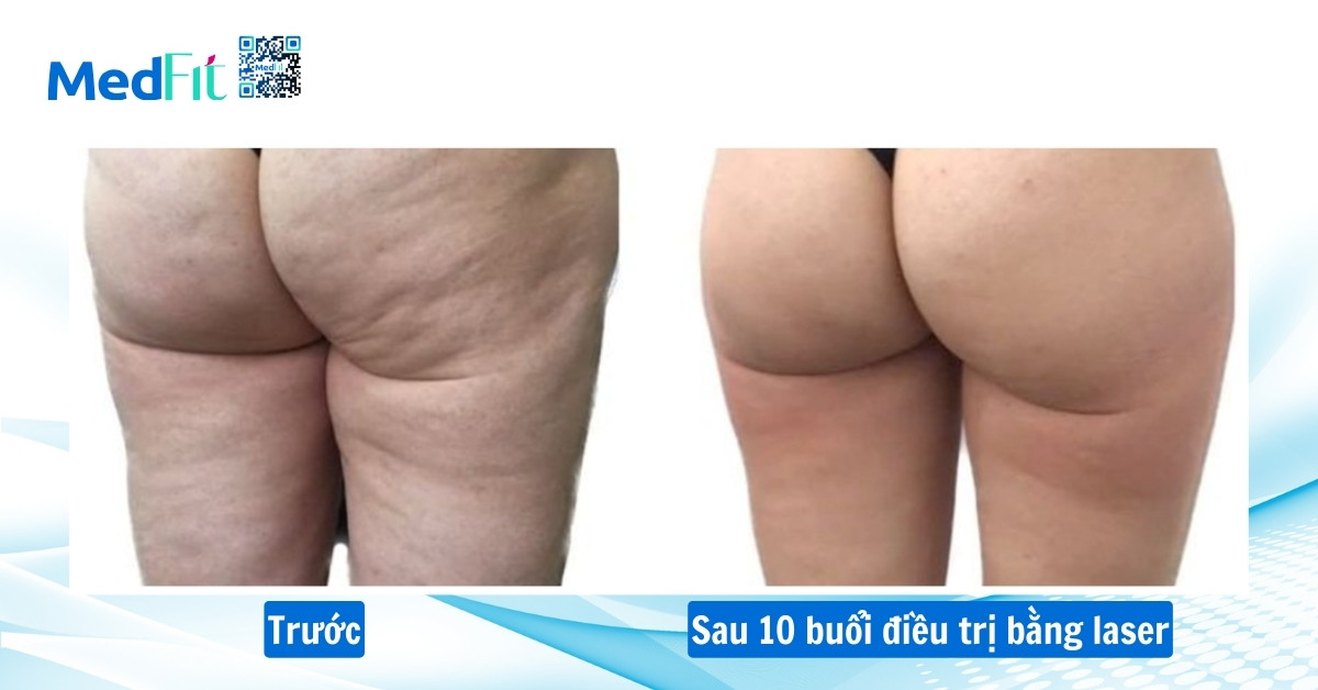 điều trị cellulite bằng laser