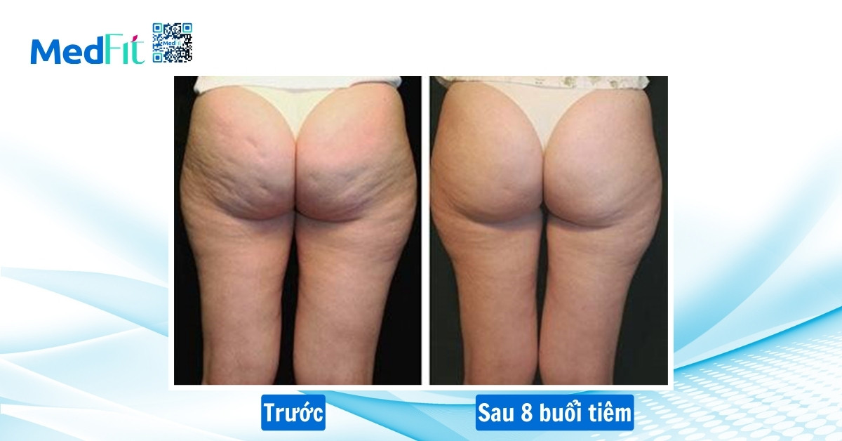 điều trị cellulite bằng tiêm giảm mỡ