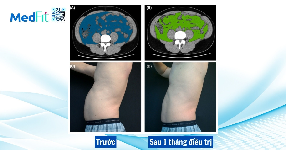 hifem có thể giảm béo bụng trên và béo bụng dưới sau 1 tháng điều trị