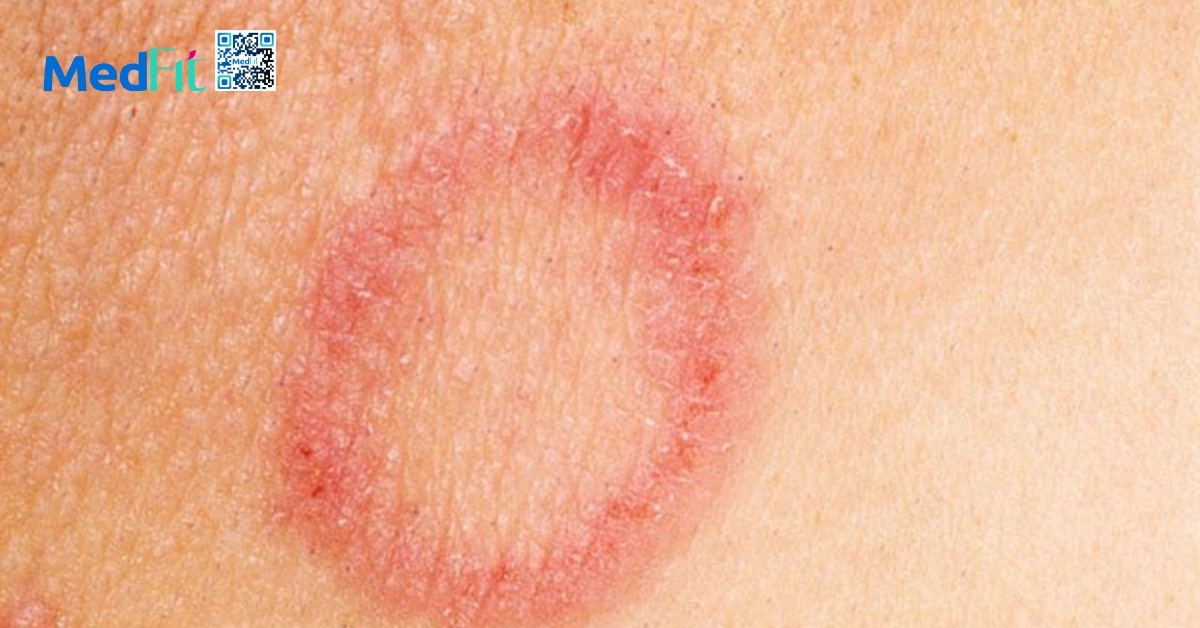 hình minh họa nhiễm nấm da (dermatophytosis)