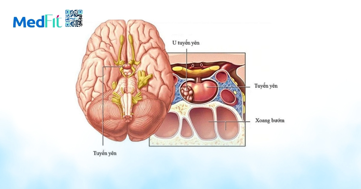 hình minh họa u tuyến yên