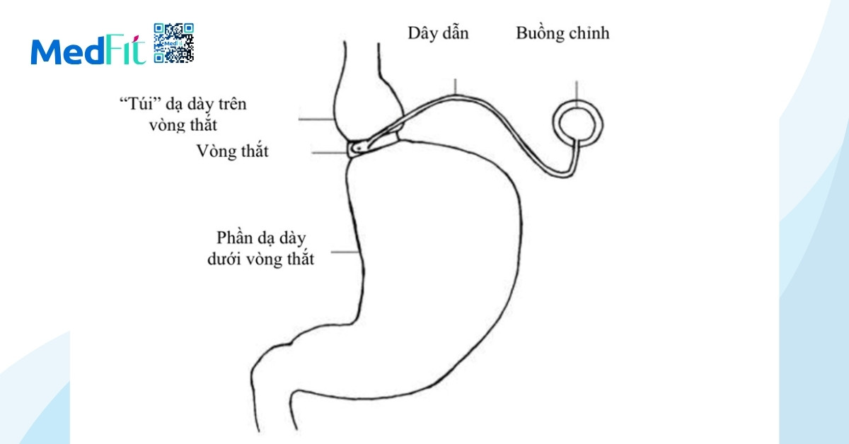 phương pháp phẫu thuật đặt vòng thắt dạ dày