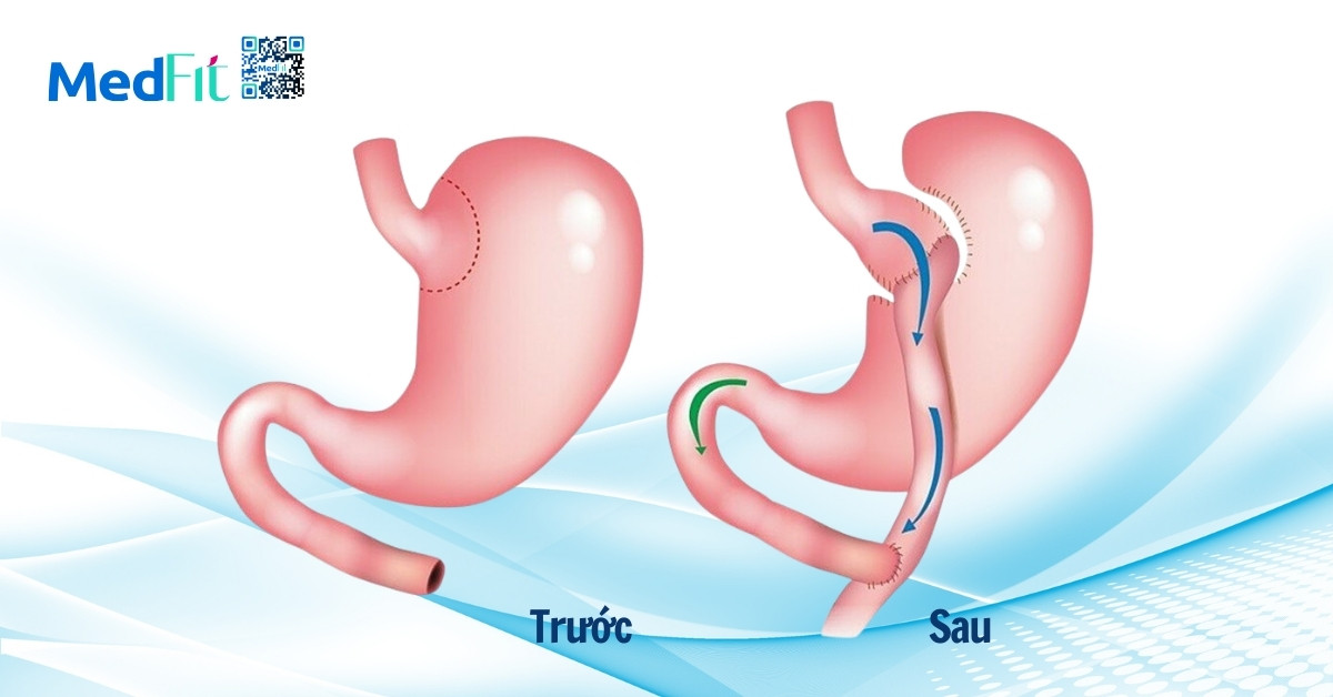 phương pháp phẫu thuật nối tắt dạ dày