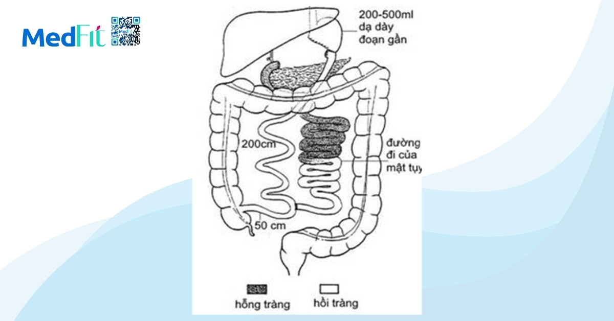 phương pháp phẫu thuật phân lưu mật tụy