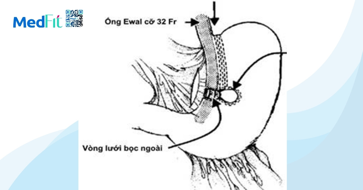 phương pháp phẫu thuật tạo hình dạ dày