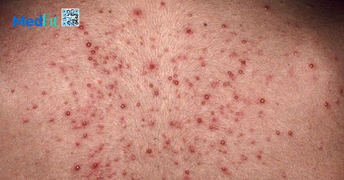 viêm nang lông (folliculitis) (hình minh họa)