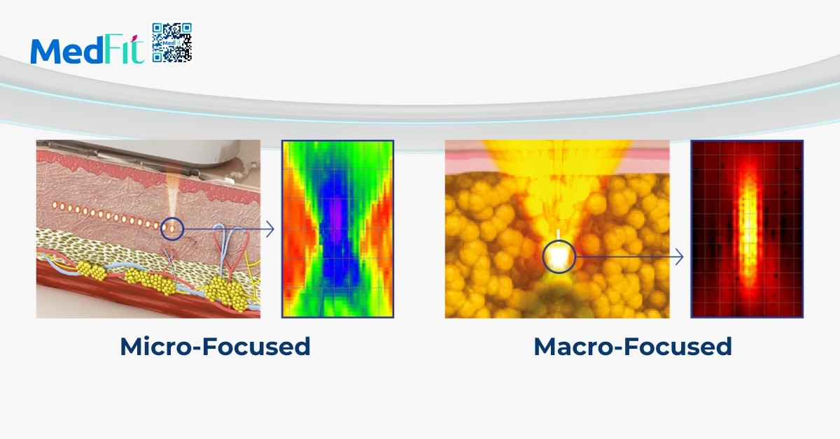 công nghệ micro-focused và macro-focused của ultraformer mpt