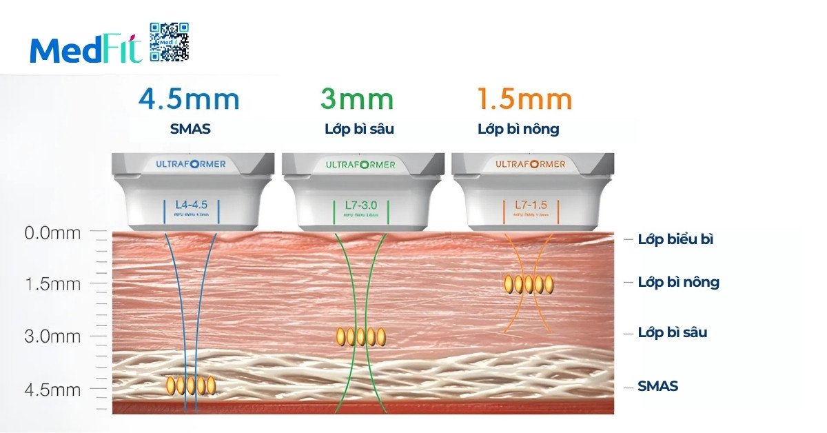 độ xuyên sâu 1,5, 3 và 4,5mm của hifu