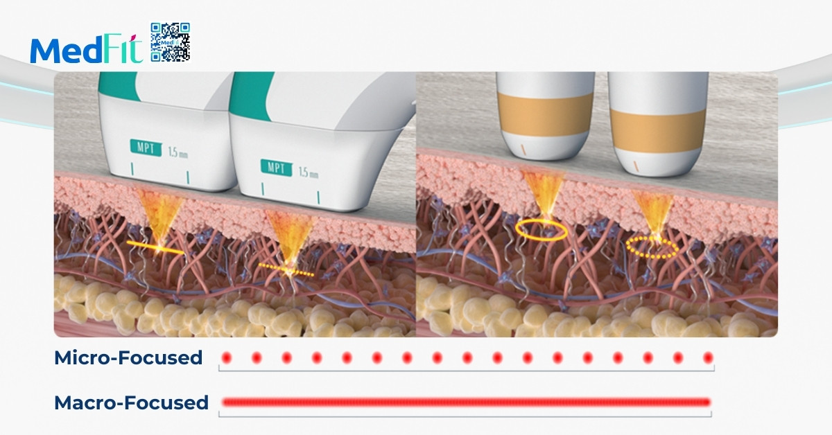 hai chế độ điều trị của máy ultraformer mpt