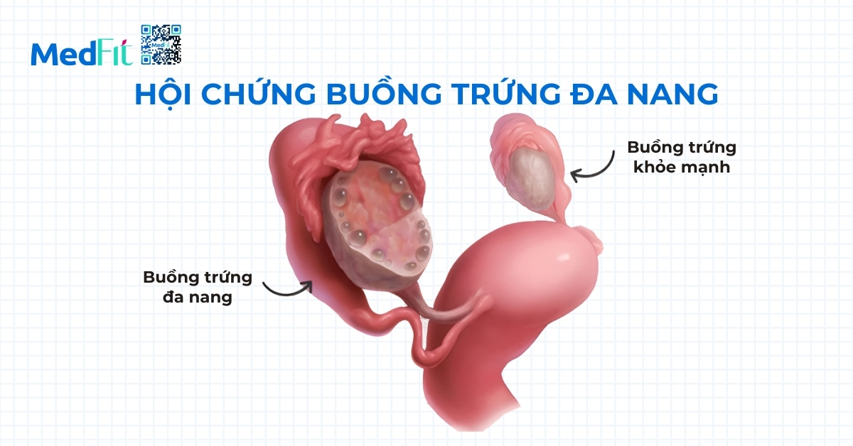 hình minh họa hội chứng buồng trứng đa nang