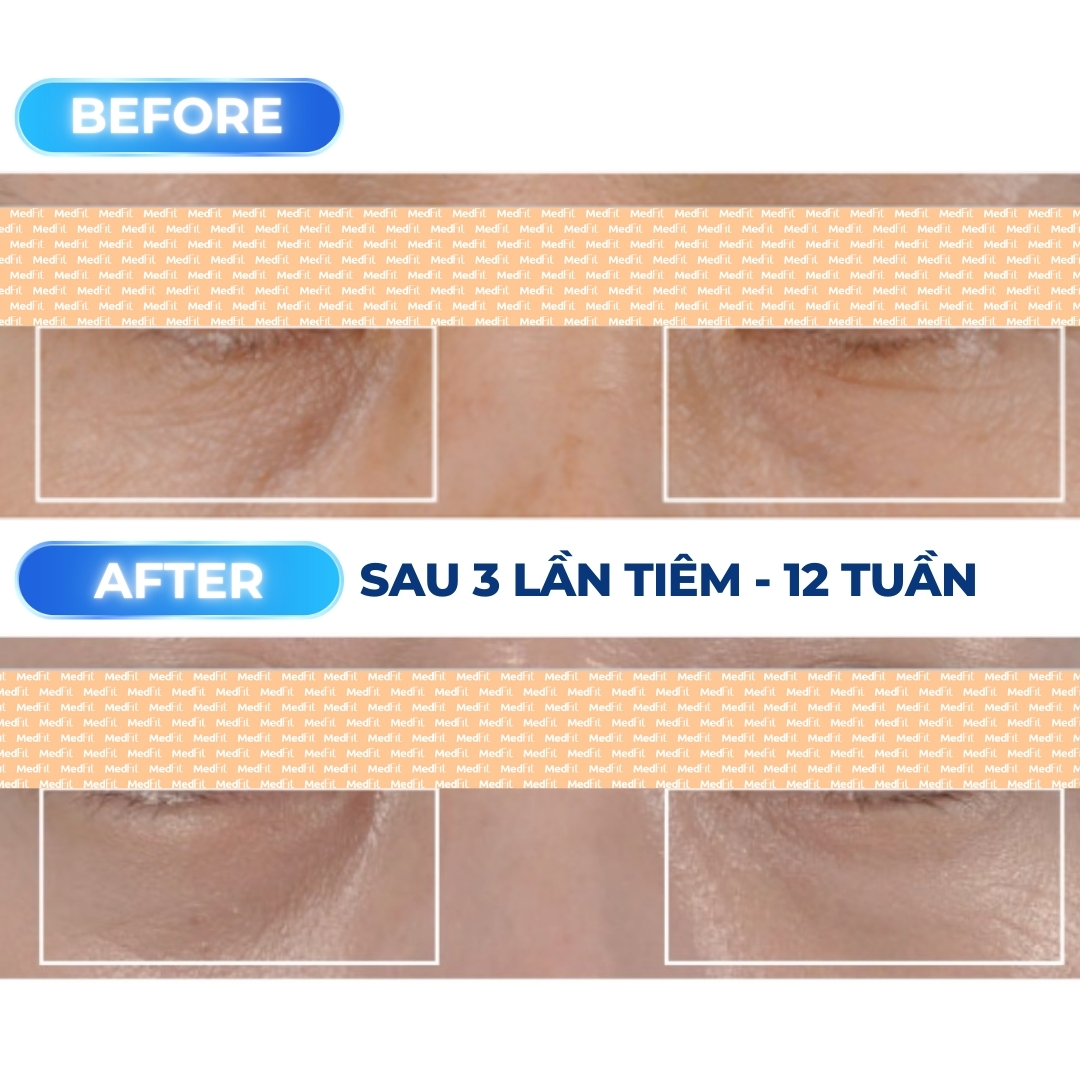 Nghiên cứu với rejuran i