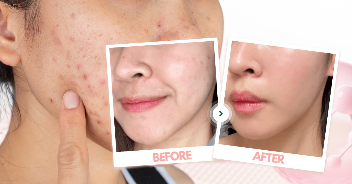 Tổn thương da sau mụn
