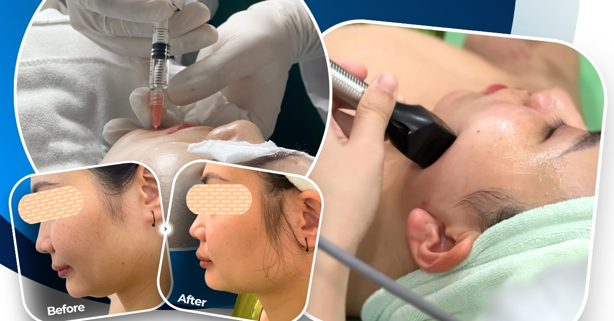 Vì sao nên chọn nâng cơ và trẻ hóa