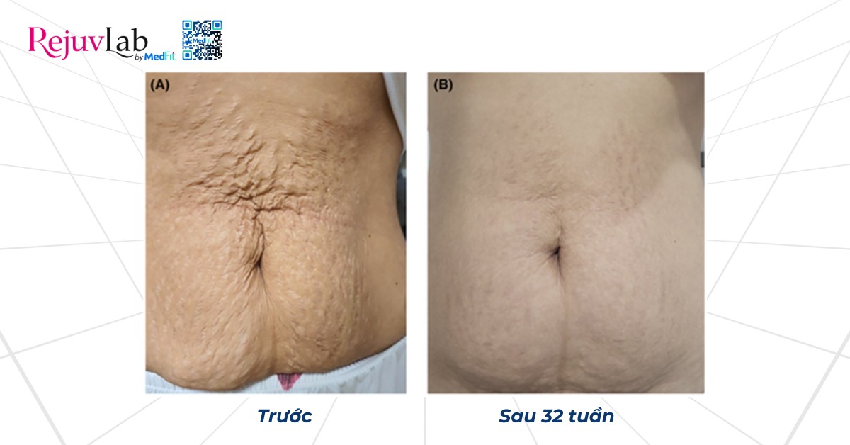 điều trị 7 buổi juvelook ở một phụ nữ 37 tuổi bị giãn vết rạn da bụng