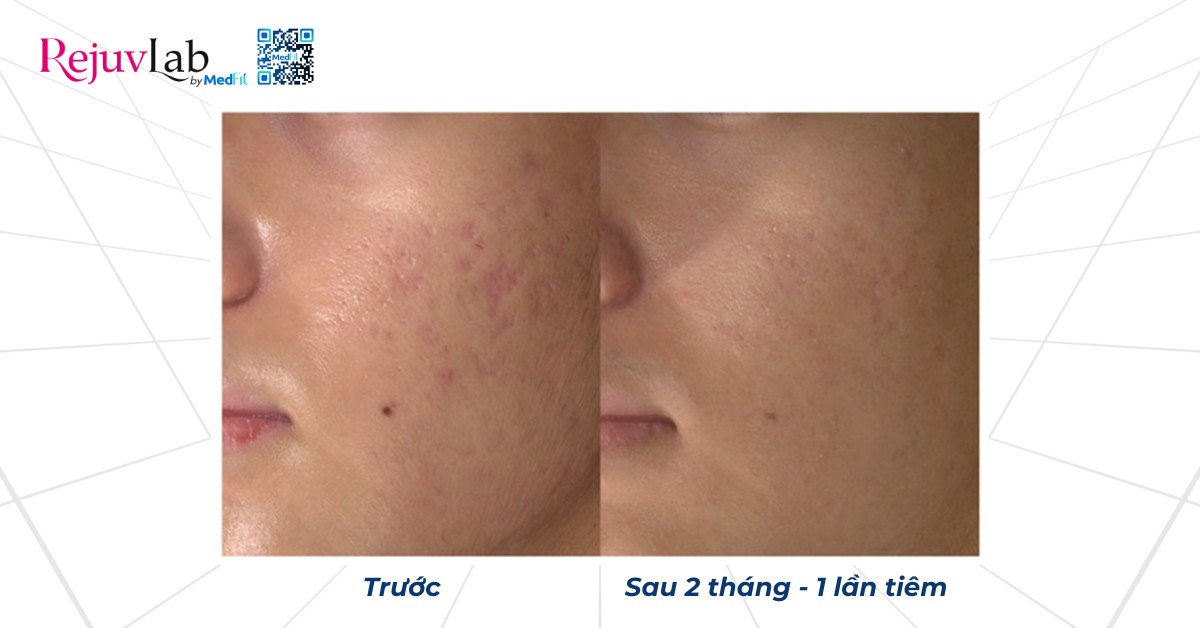 hiệu quả điều trị sẹo sau 2 tháng sau 1 lần tiêm juvelook