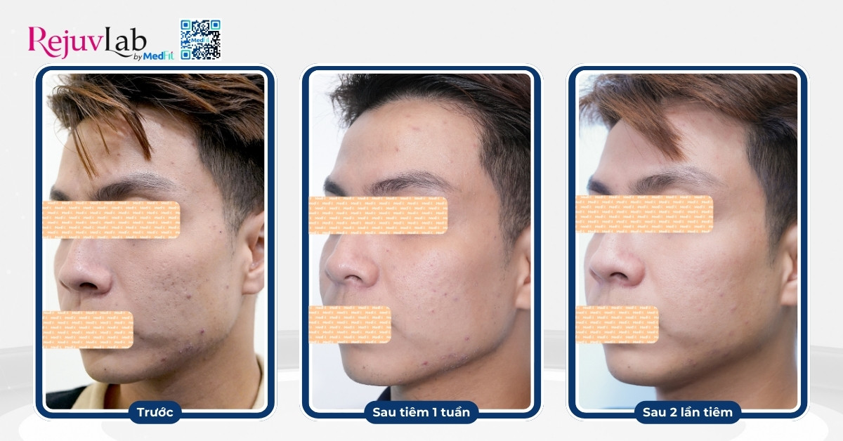 hiệu quả tiêm belotero revive sau 2 lần tiêm