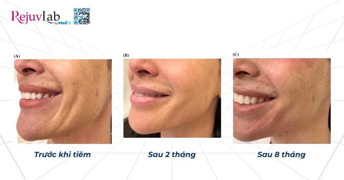 hiệu quả trẻ hoá da khi tiêm juvederm volite bằng kim tiêm ở 1 người phụ nữ 43 tuổi