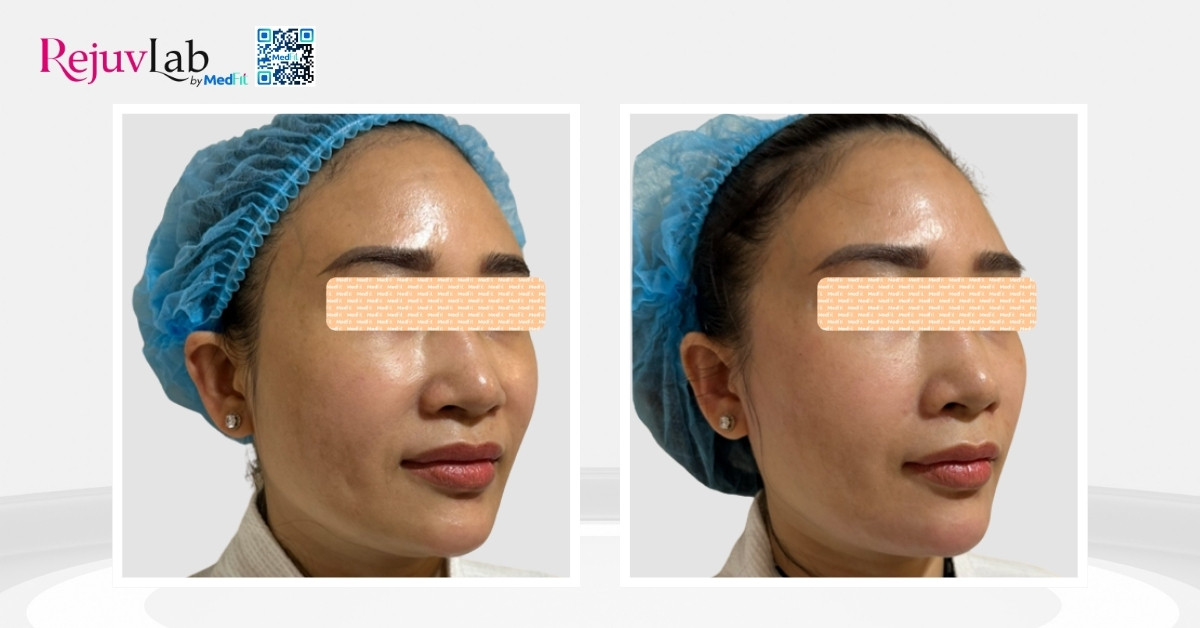 hình ảnh trước và sau khi tiêm radiesse