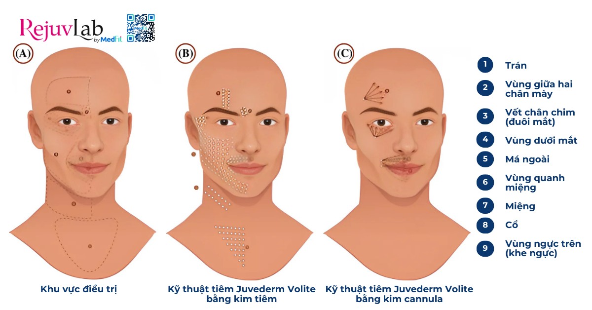 kỹ thuật tiêm juvederm volite