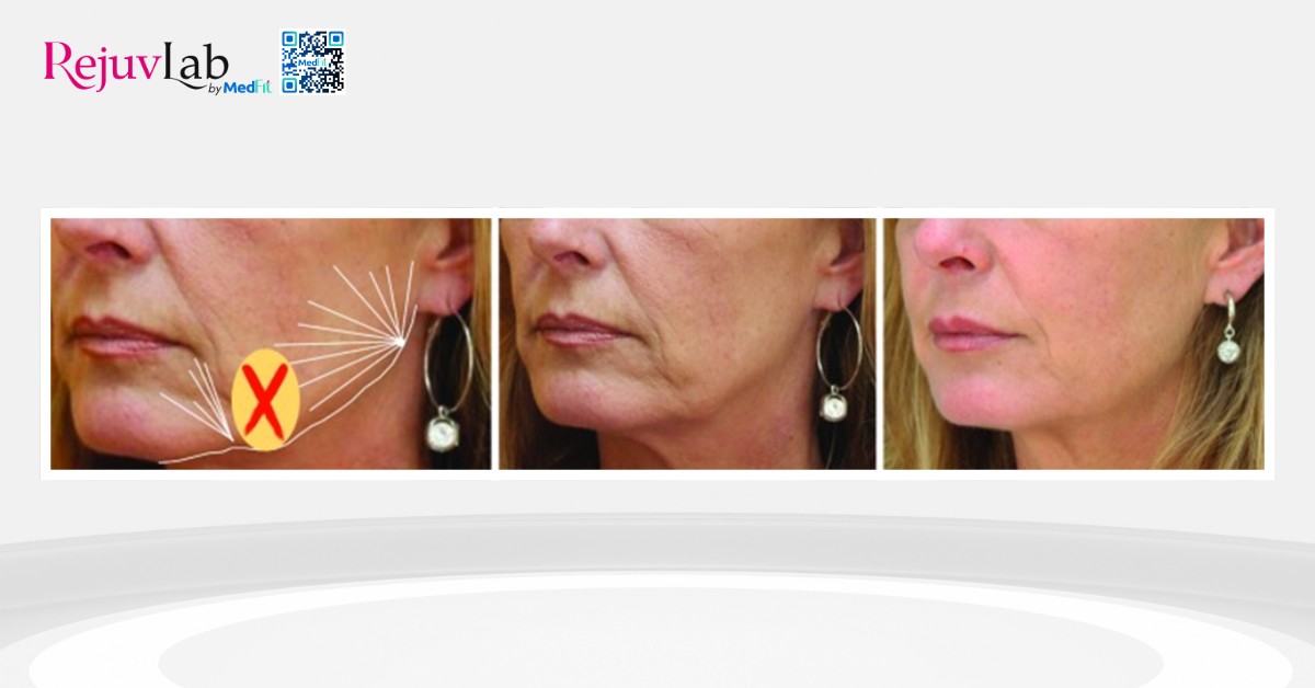 radiesse được chỉ định để cải thiện đường viền hàm dưới