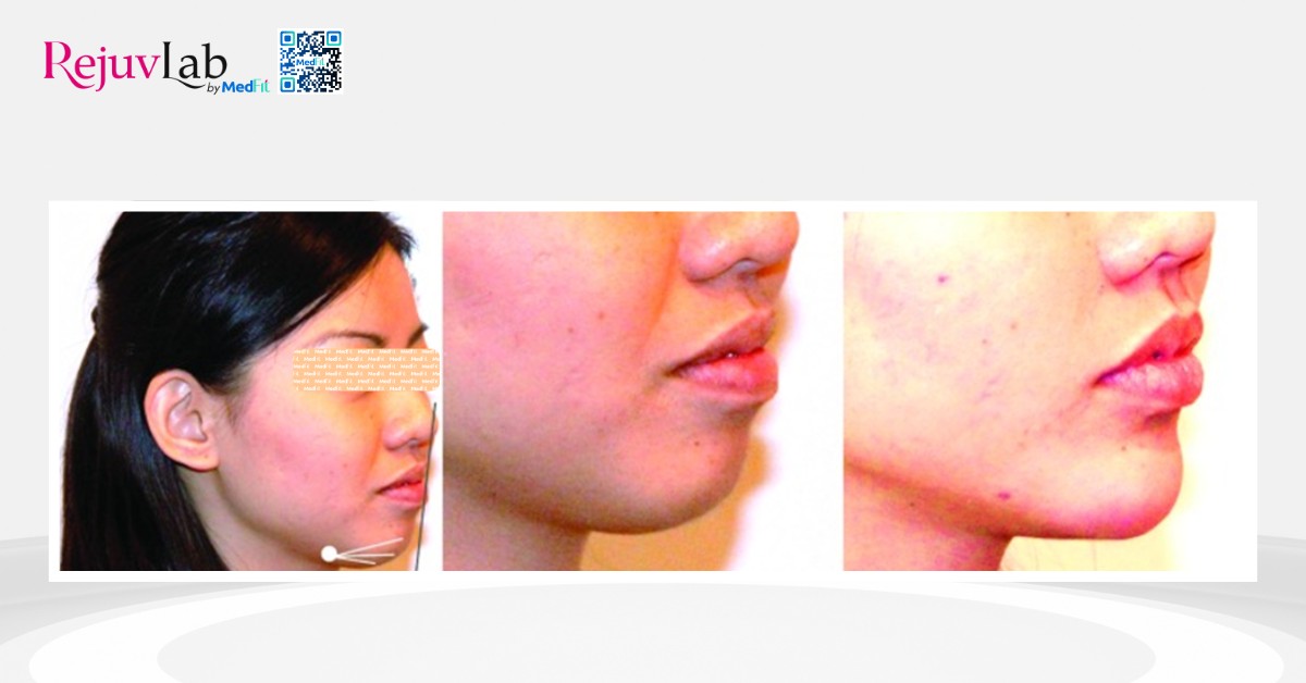 radiesse được chỉ định để định hình lại vùng cằm