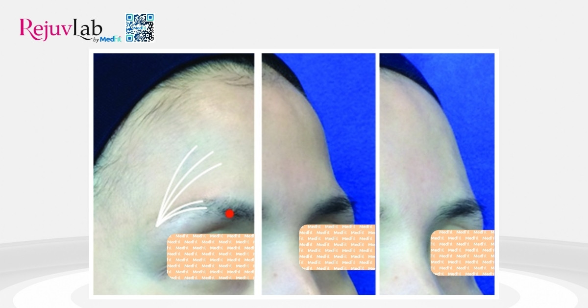 radiesse được chỉ định để khắc phục tình trạng lõm trán