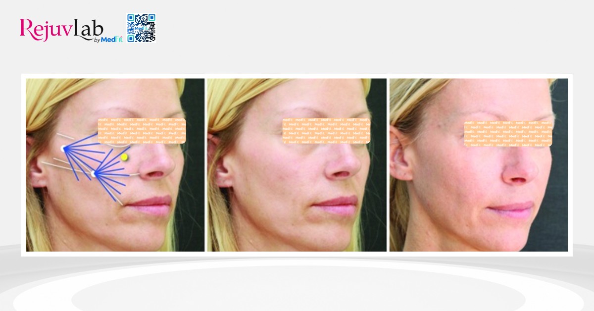radiesse được chỉ định để khôi phục độ đầy đặn của má