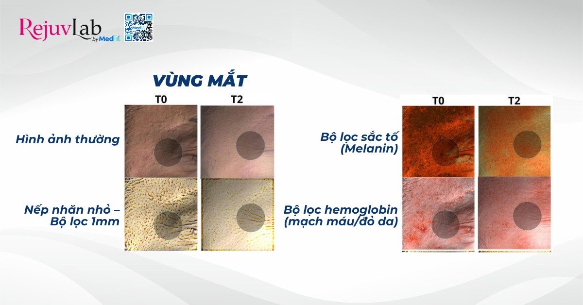 Tiêm BAP Karisma Rh Collagen - Bí quyết trẻ hóa và tái tạo da cực hot hiện nay 5 ảnh chụp hiệu quả trẻ hoá vùng mắt sau khi tiêm karisma được lấy từ nghiên cứu của rosa và cộng sự