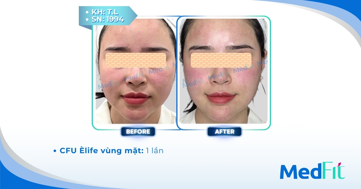 ca lâm sàng cfu tại medfit