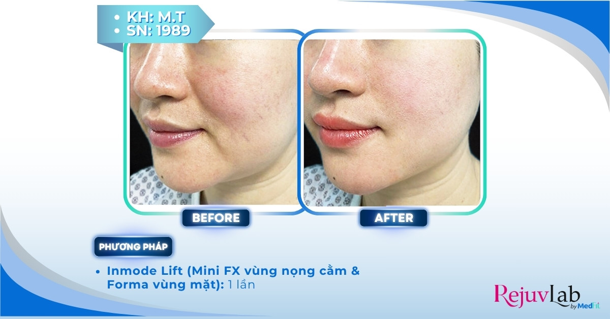 ca lâm sàng điều trị nếp nhăn marionette bằng forma