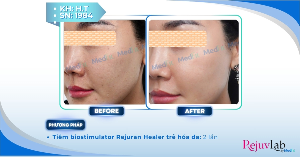 Rejuran Skin Healer – Giải pháp phục hồi và trẻ hoá da toàn diện 9 ca lâm sàng điều trị với rejuran