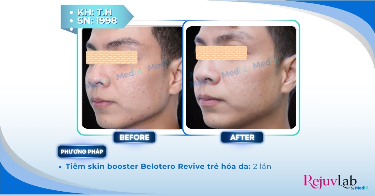 Hyaluronic acid là gì và ứng dụng trong thẩm mỹ da 9 ca lâm sàng tiêm belotero