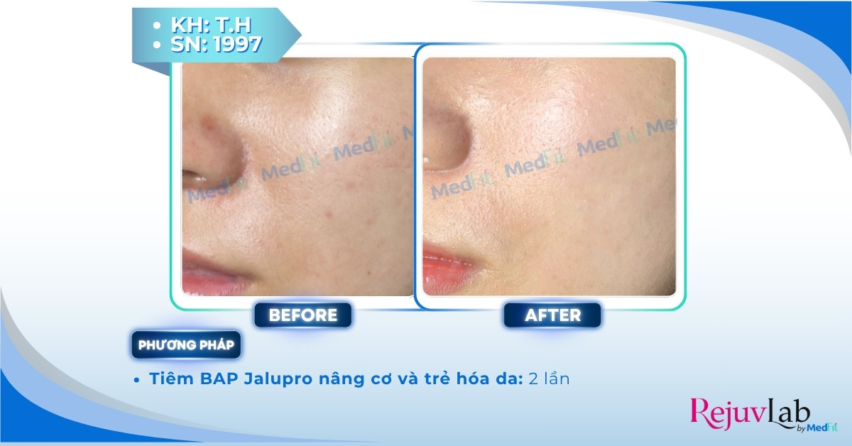 Hyaluronic acid là gì và ứng dụng trong thẩm mỹ da 8 ca lâm sàng tiêm jalupro