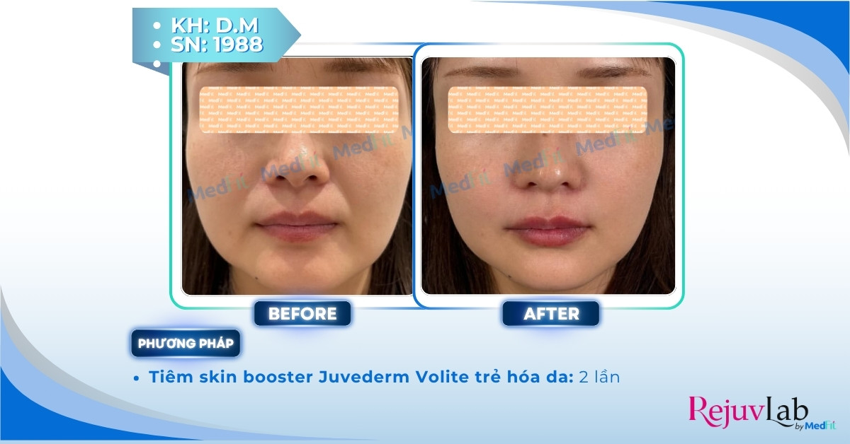 Hyaluronic acid là gì và ứng dụng trong thẩm mỹ da 5 ca lâm sàng tiêm juvederm volite