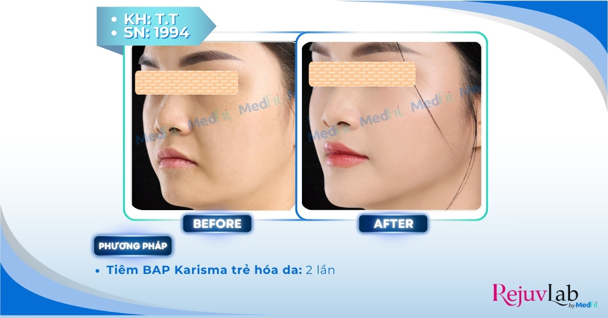 Làm sao để làm mờ rãnh mũi má? 11 ca lâm sàng tiêm karisma làm mờ rãnh mũi má