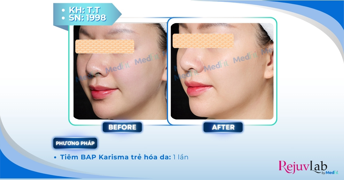 Tiêm BAP Karisma Rh Collagen - Bí quyết trẻ hóa và tái tạo da cực hot hiện nay 4 ca lâm sàng tiêm karisma tại medfit