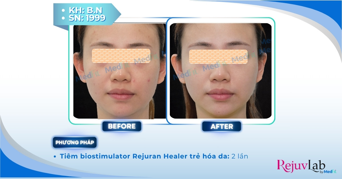 Rejuran Skin Healer – Giải pháp phục hồi và trẻ hoá da toàn diện 10 ca lâm sàng tiêm rejuran