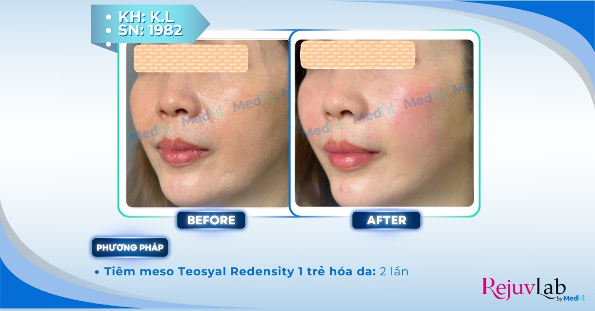 Teosyal Redensity 1 - Tái sinh làn da tươi trẻ, khơi dậy sức sống tự nhiên 4 ca lâm sàng tiêm teosyal redensity 1 tại medfit