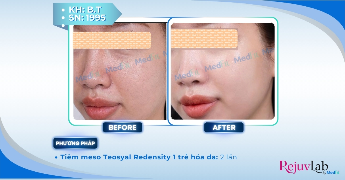 Teosyal Redensity 1 - Tái sinh làn da tươi trẻ, khơi dậy sức sống tự nhiên 5 ca lâm sàng tiêm teosyal redensity 1