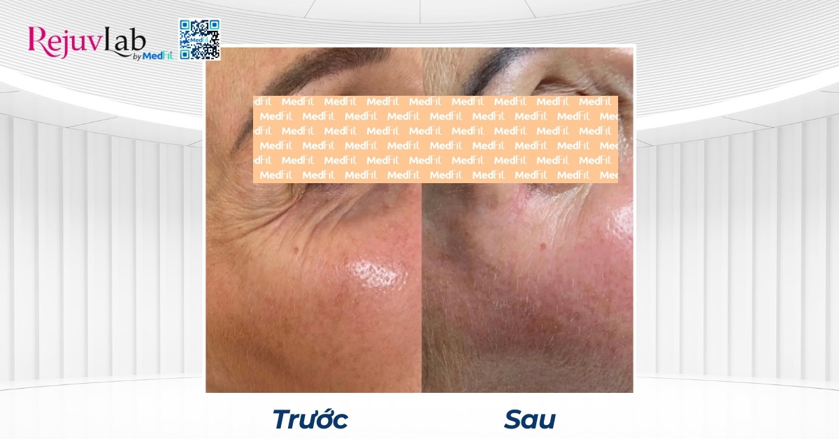 các nếp nhăn trên da được cải thiện sau khi tiêm jalupro
