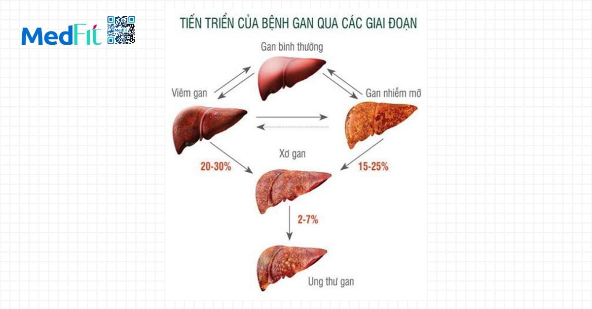 Gan nhiễm mỡ do rối loạn chuyển hóa và béo phì 4 các tiến triển của bệnh gan
