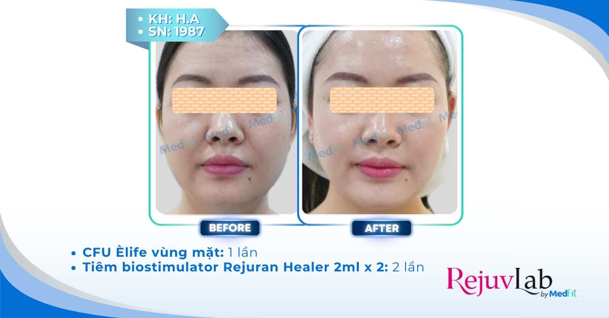Cấy chỉ collagen làm đầy má hóp có thực sự hiệu quả? 7 cls làm cfu và rejuran tại rejuvlab
